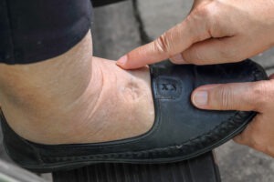 two hands pushing on the swollen foot of someone wearing a black shoe