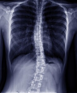 Social Security Disability for Scoliosis